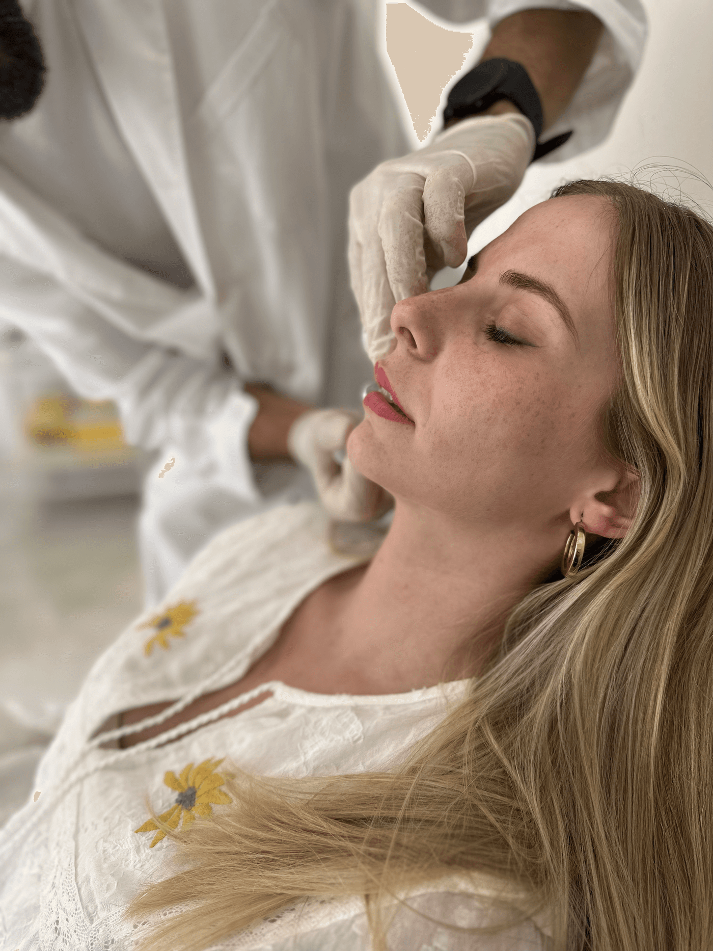 Resultado de relleno de labios con ácido hialurónico — Clínica Pura Vida Valencia